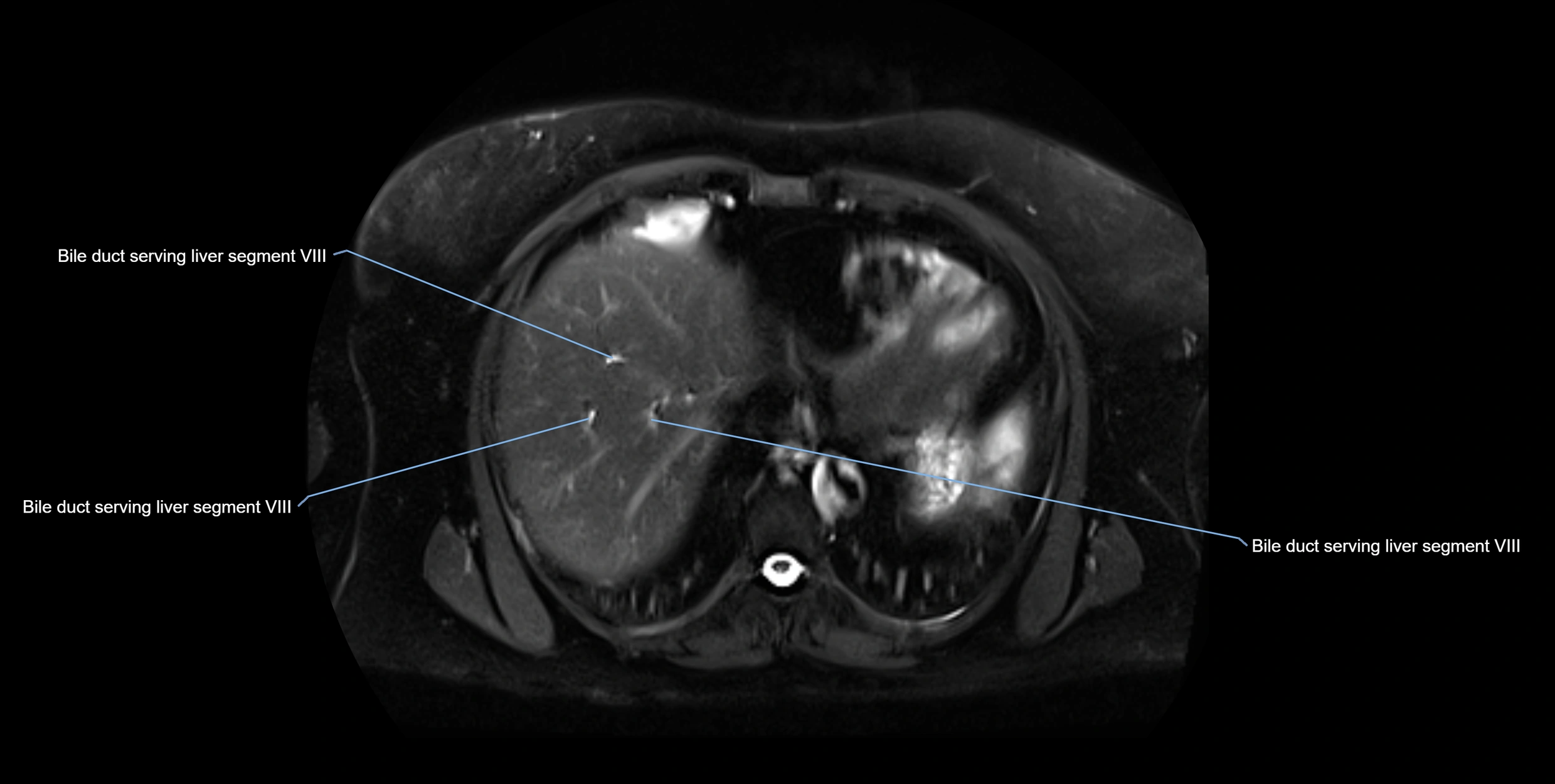 MRI MRCP axial cross sectional anatomy 3T radiology  image-img-10001-00007.webp